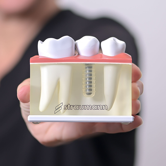 Dental professional holding a model of a dental implant in the jaw