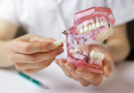 Dentist placing a dental bridge over two implants in a model of the mouth