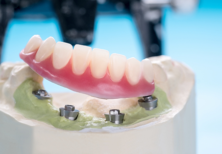 Model of an implant denture on a desk