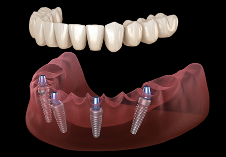 Illustration of a full denture being placed onto four dental implants