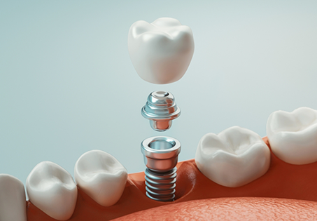 Illustration of a dental implant with a crown replacing a missing tooth