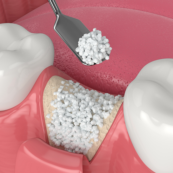 Illustration of bone grafting material being placed into the jawbone