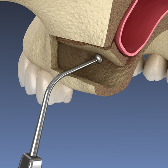 Illustration of a metal instrument gently lifting up the sinus membrane