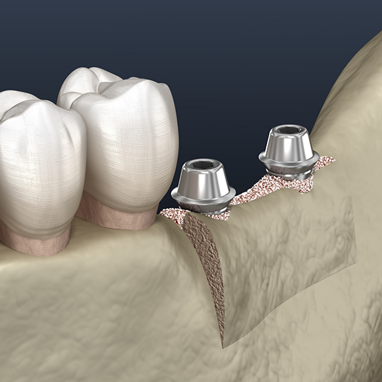 Illustration of two dental implant posts in the jawbone