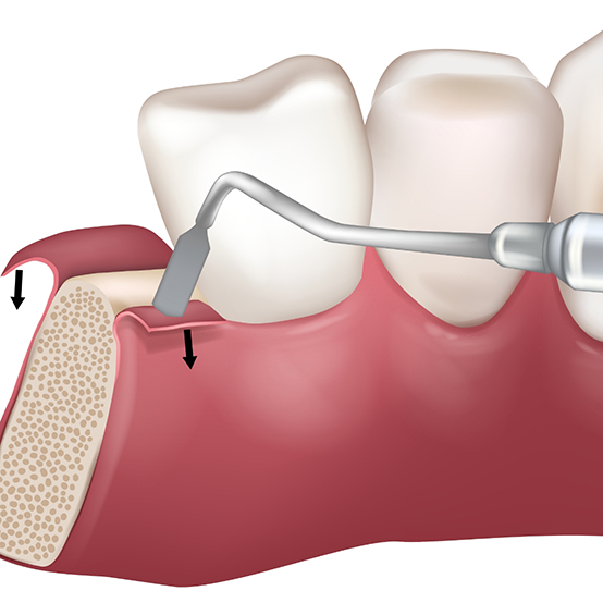 Illustration of gum tissue being moved to access the jawbone