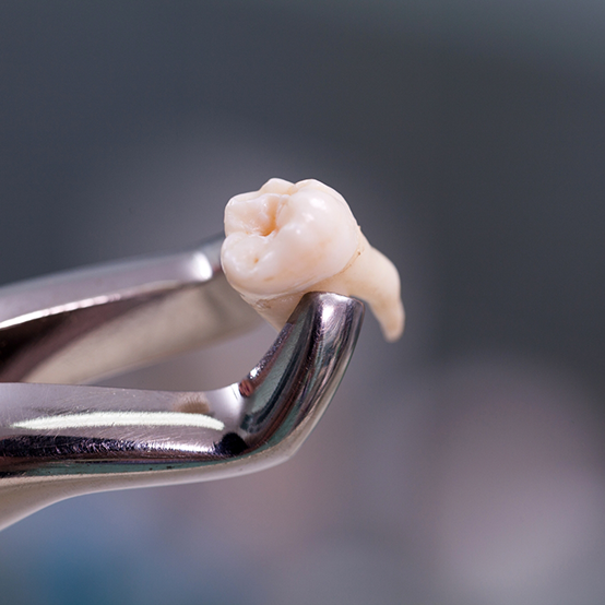 Clasp holding an extracted tooth