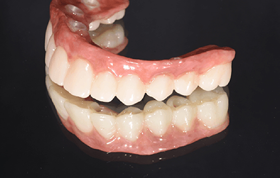 Implant denture against black background