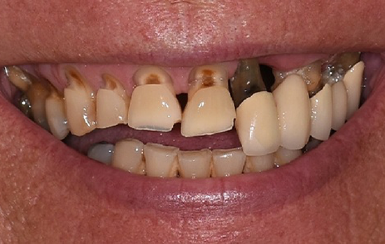 Close up of a smile with multiple severely damaged teeth